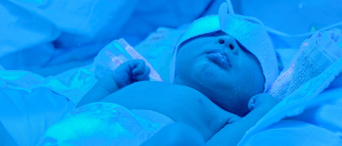 Ett spädbarn som behandlas med fototerapi